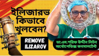 Removal of Ilizarov | ইলিজারভ কিভাবে খুলবেন | Ilizarov | Dr.M.Sharif Uddin Liton